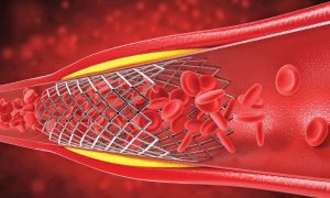 Cardiac Stents