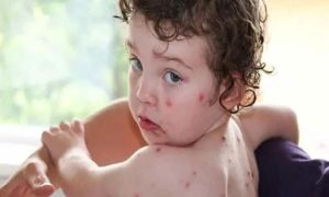 Measles, Punjab, Multan, Health Department, WHO,