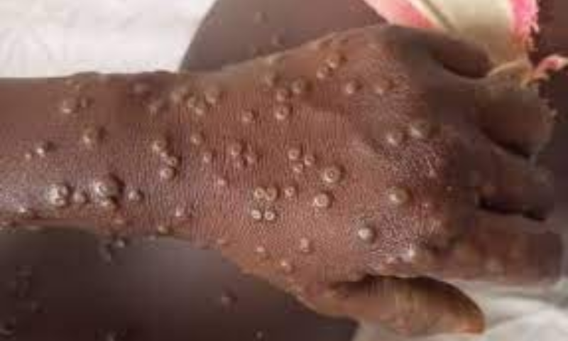 Mpox, Cases, Public, Zika, Increase