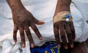 Morocco, First Monkeypox Case, Africa,